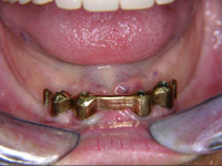 Keramikkrone auf Implantat