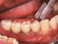 Keramikkrone auf Implantat
