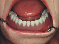 Keramikkrone auf Implantat